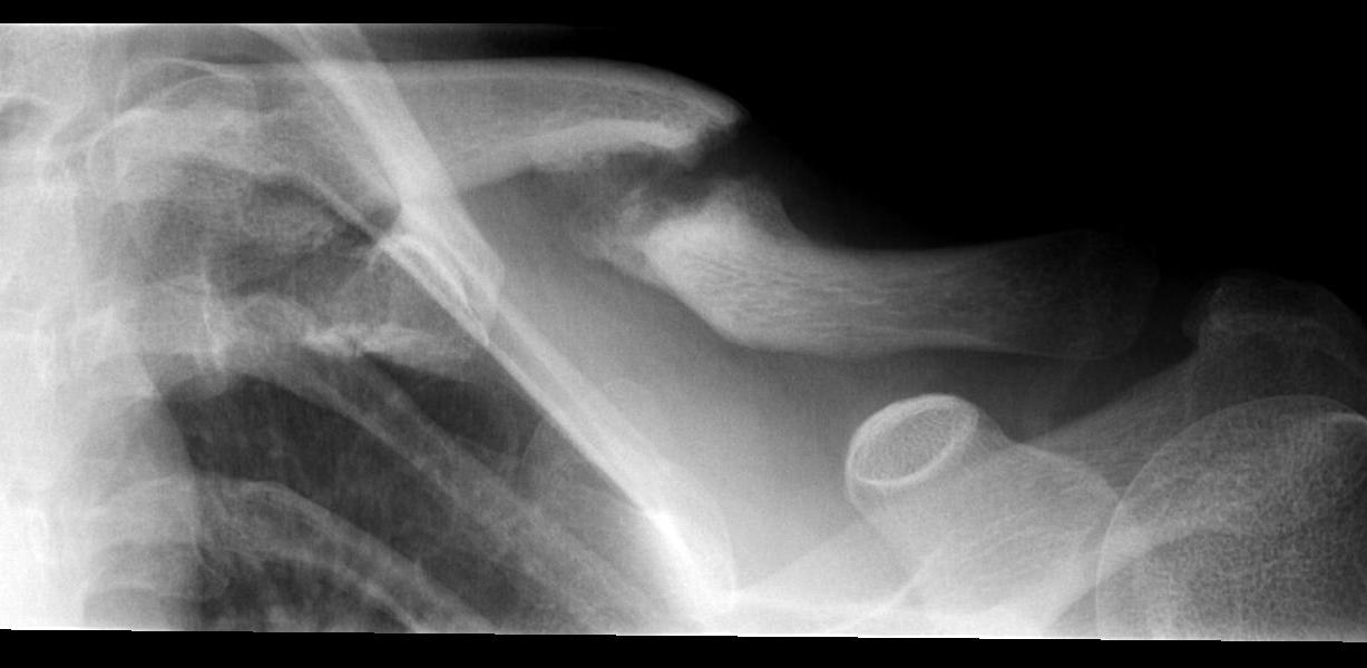 Clavicle Non Union